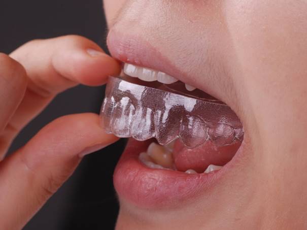 투명교정 장치 착용